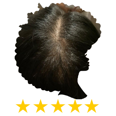 I had a bald spot on top of my head and after using the growth oil for 1 month my hair has almost completely filled in.